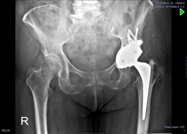 Revision Total Hip Replacement