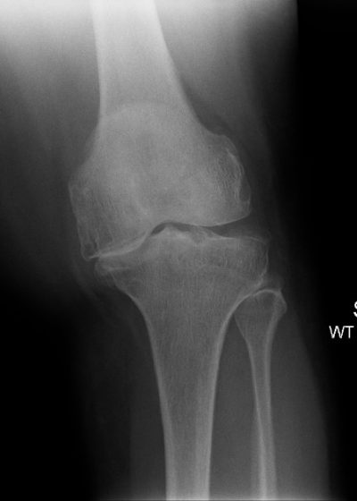 Robotic Total Knee Replacement – Knee and Hip Surgery London